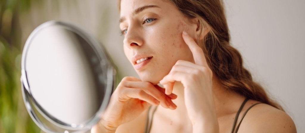 Πανάδες στο πρόσωπο