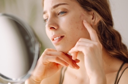 Πανάδες στο πρόσωπο